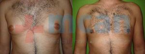 Gynecomastia