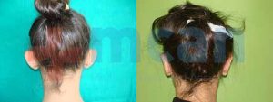 Ear Correction