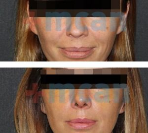 Before-After Affordable Rhinoplasty In Turkey | Nose Job in Turkey | MCAN Health Before-After