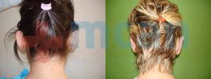 Ear Correction