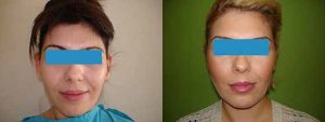 Facelift