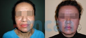 Facelift