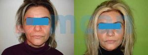 Facelift