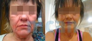 Facelift