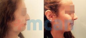Before-After Affordable Rhinoplasty In Turkey | Nose Job in Turkey | MCAN Health Before-After