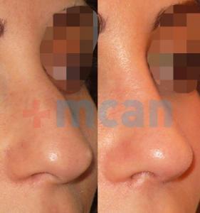 Before-After Affordable Rhinoplasty In Turkey | Nose Job in Turkey | MCAN Health Before-After