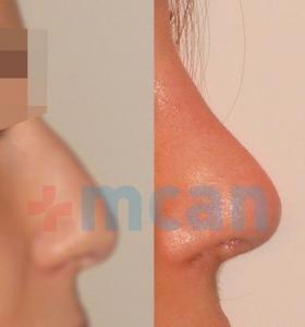 Before-After Affordable Rhinoplasty In Turkey | Nose Job in Turkey | MCAN Health Before-After