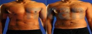 Vaser Liposuction Before-After