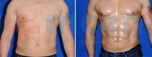 Vaser Liposuction Before-After