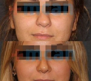 Before-After Affordable Rhinoplasty In Turkey | Nose Job in Turkey | MCAN Health Before-After