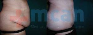 Before-After Tummy Tuck