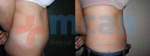 Liposuction + Tummy Tuck Before-After