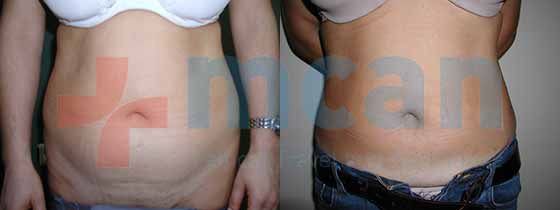 before and after mini tummy tuck recovery before and after mini tummy tuck recovery