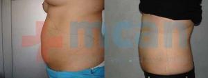 Liposuction Before-After