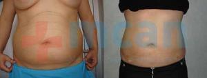 Liposuction Before-After