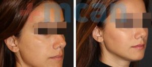 Antes y después del aumento de pómulos con inyección de grasa