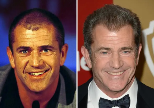 celebrity hair transplants before and after-Mel Gibson