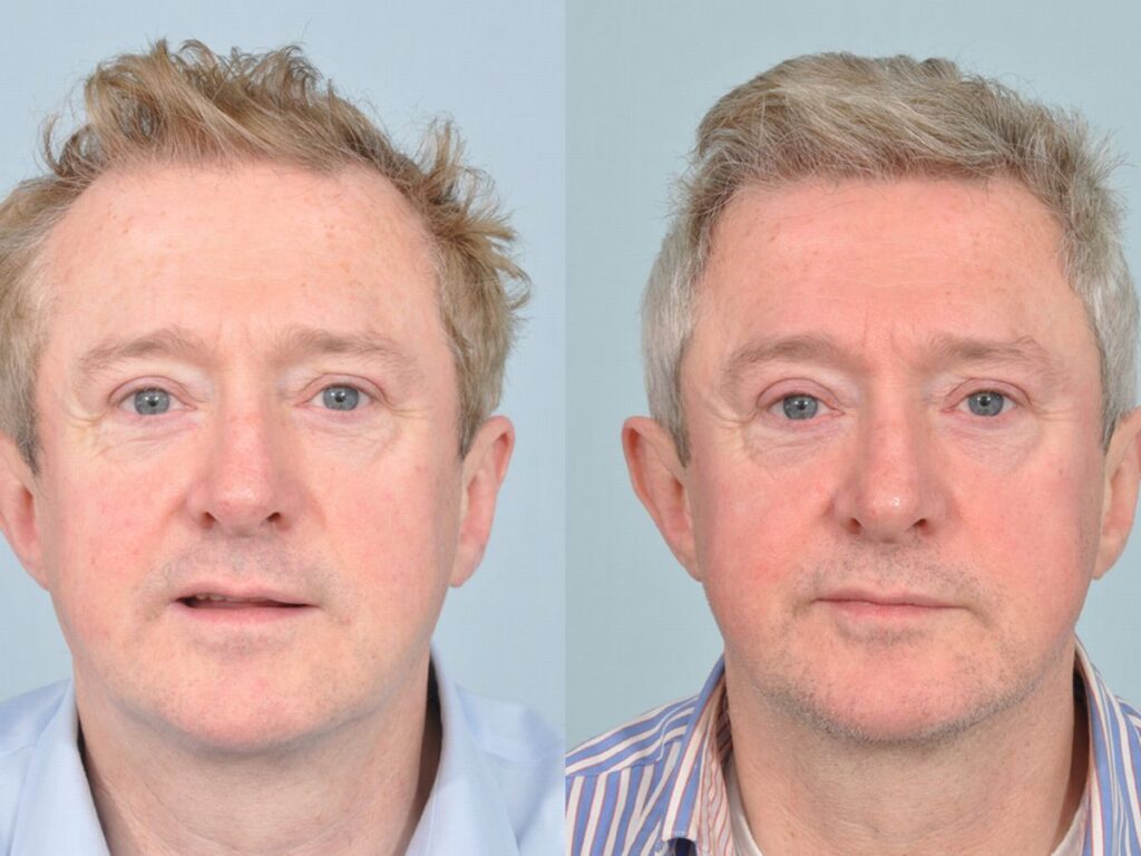 Celebrity Hair Transplant Stories and Before and After Photos 13 Louis Walsh hair transplant famous people hair transplant- Louis Walsh