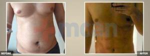 High Def Liposuction Before – After