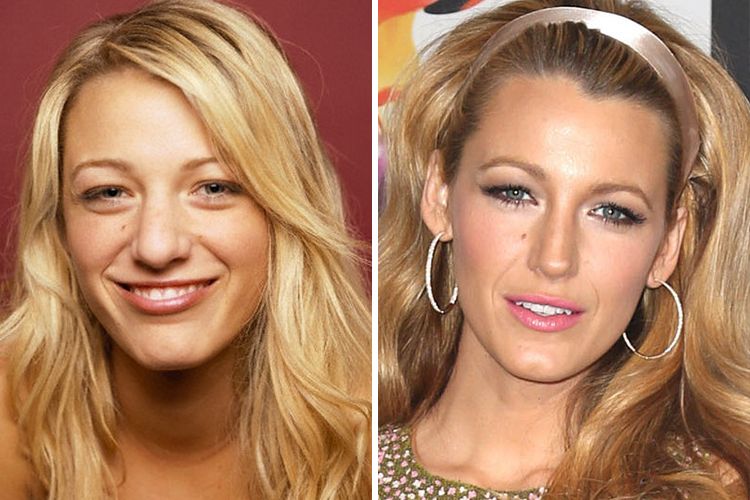 Blake Lively Nose Job