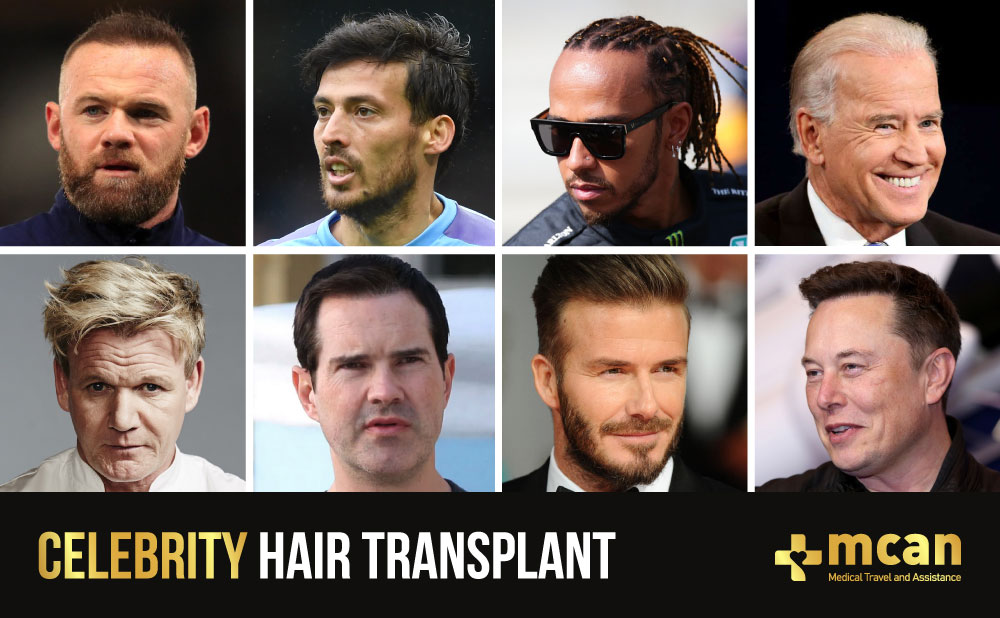Celebrity Hair Transplants and their before and after photos