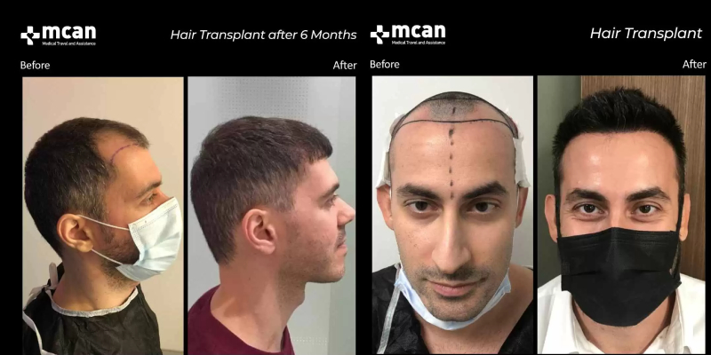 hair transplant turkey