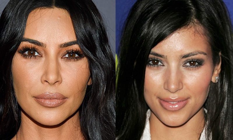 Kim Nose Job 