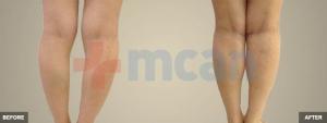 Before-After Calf Implant