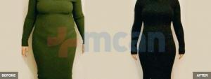 Mega Liposuction + Tummy Tuck Before-After