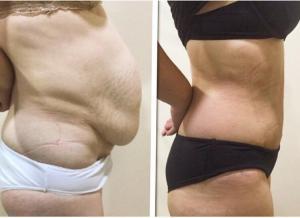 Antes y después de la liposucción y abdominoplastia