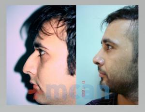 Before-After Rhinoplasty