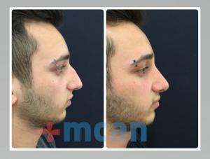 Before-After Rhinoplasty