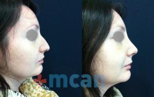 Before-After Rhinoplasty