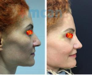 Before-After Rhinoplasty