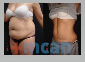 Antes y después de la liposucción y abdominoplastia en Turquía