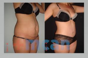 Liposuction+Tummy Tuck Before-After