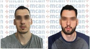 Antes y después del trasplante de barba