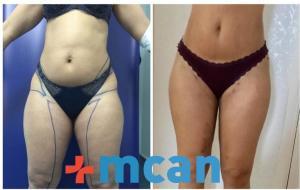 Antes y después de liposucción | MCAN Health