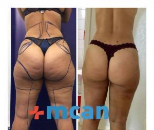 Antes y después de liposucción | MCAN Health