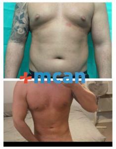 Liposuction before after | MCAN Health