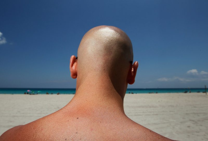 Direct sun on head after hair transplant e1655373566966