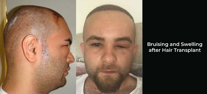 head swelling after hair transplant