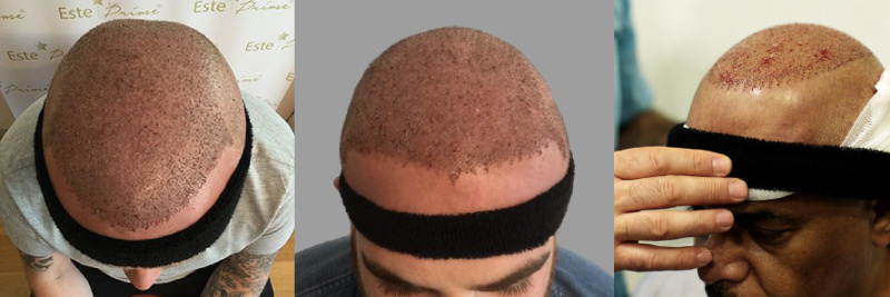 Headbands prevent swelling and bruising after hair transplant
