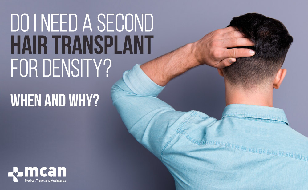 When Do I Need a Second Hair Transplant to Fix the Density? When Do I Need a Second Hair Transplant to Fix the Density?