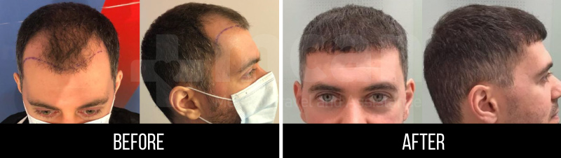 Hair transplant results before and after 