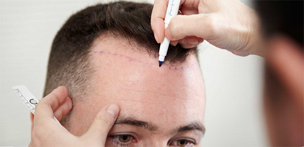 Haartransplantation Turkey