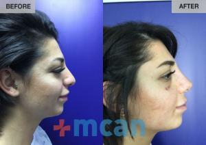 Before-After Rhinoplasty