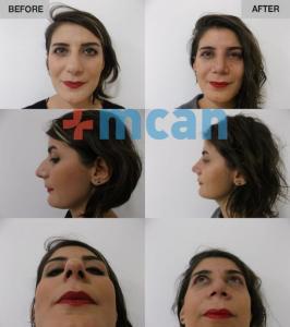 Before-After Rhinoplasty