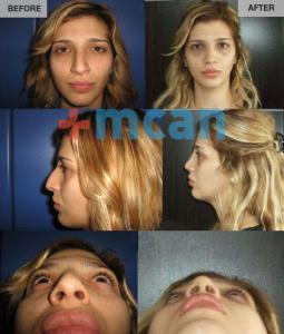 Before-After Rhinoplasty