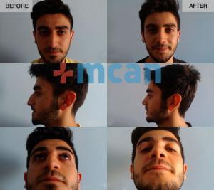 Before-After Rhinoplasty
